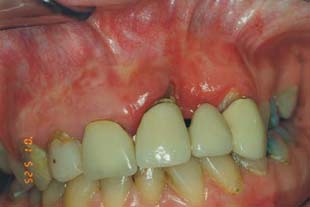 Zahnimplantate: ästhetische Lösung
